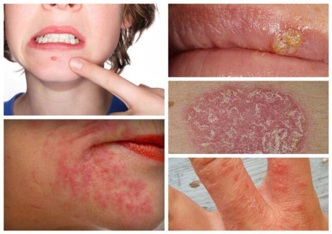 Les allergies et les maladies de la peau sont des signes de parasites dans le corps. 
