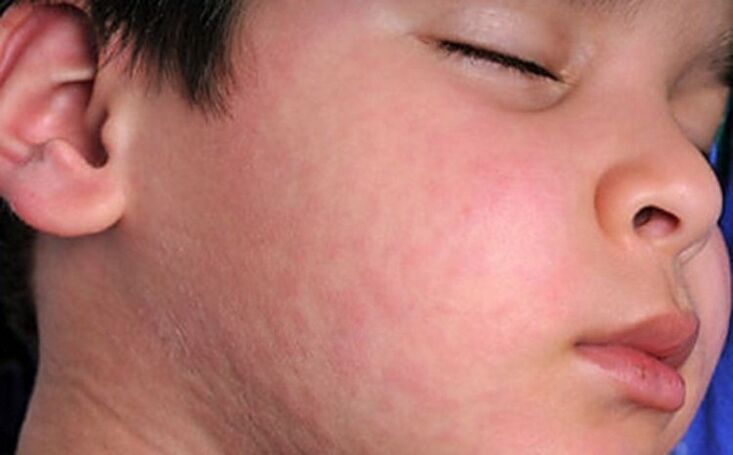 Éruptions cutanées allergiques sur la peau, symptôme de la présence de vers parasites dans le corps