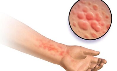 Manifestations de la schistosomose chez l'homme